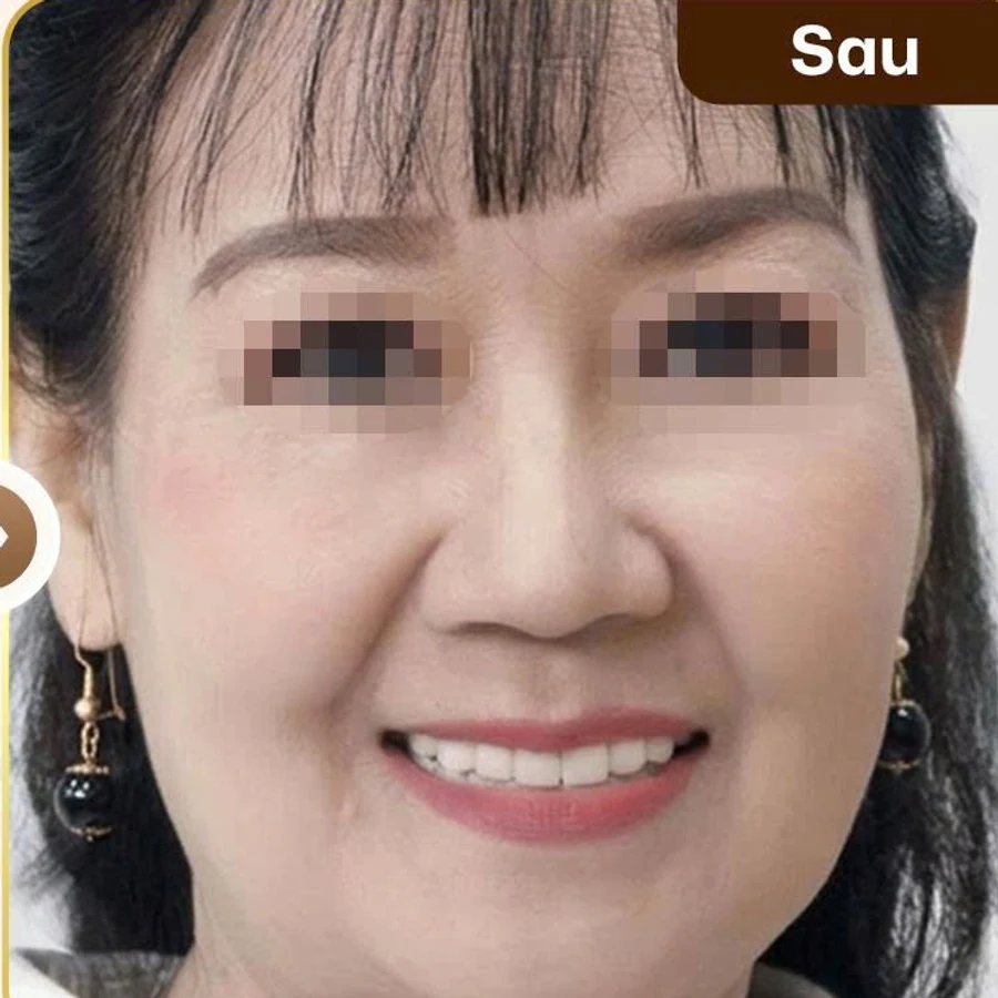 Răng sứ thẩm mỹ — Sau