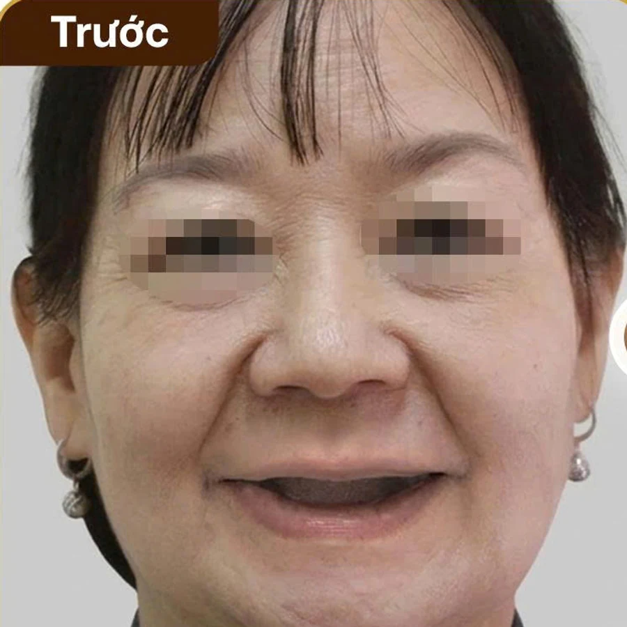 Răng sứ thẩm mỹ — Trước