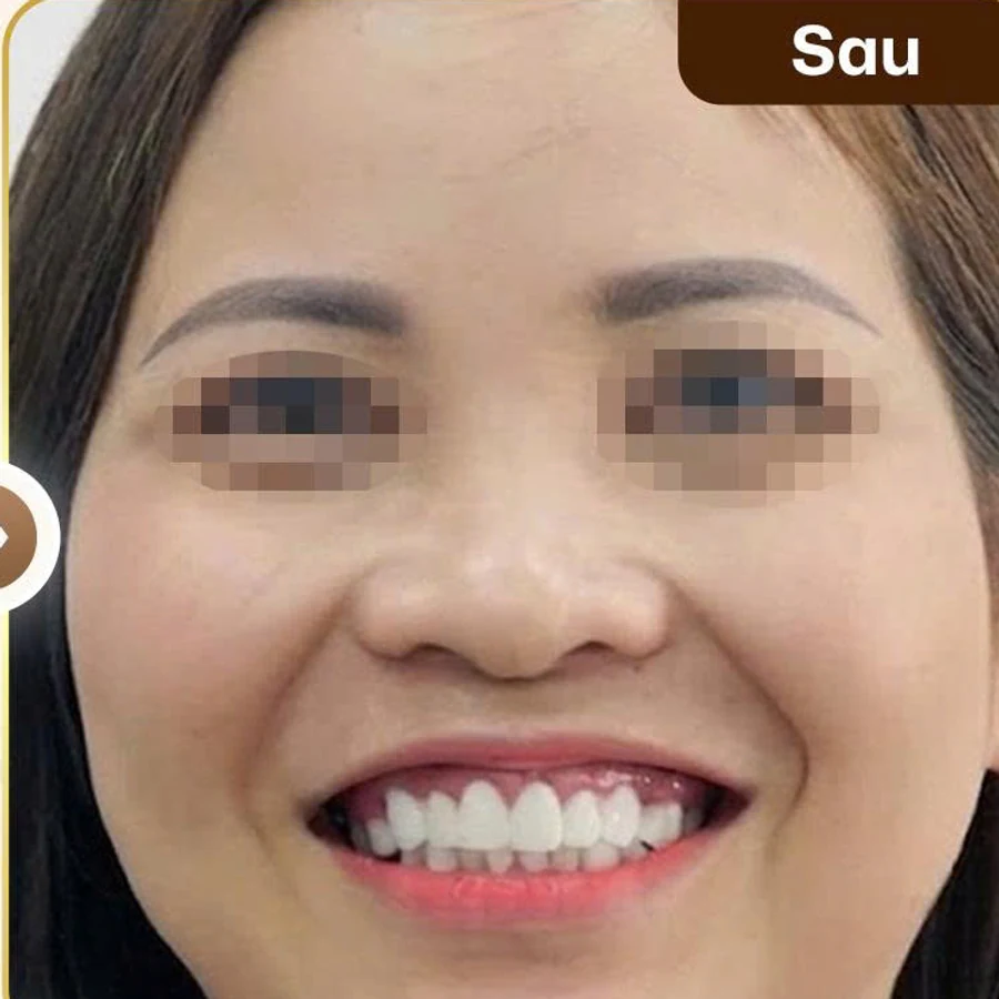 Trồng răng Implant — Sau