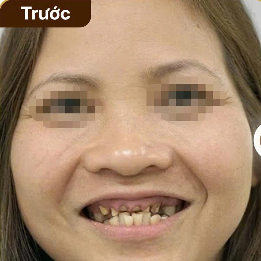Trồng răng Implant — Trước